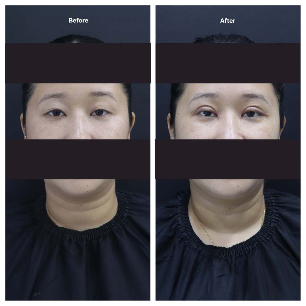 Eyelid Surgery KOQ10